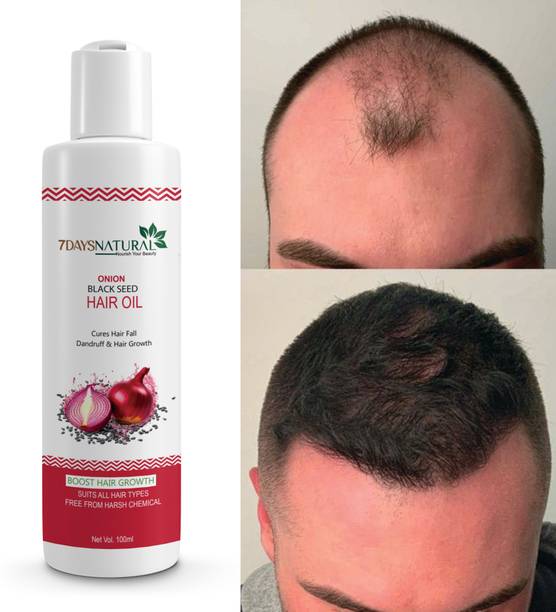 7 Days Red Onion Hair Oil Controls Hair Fall - No Miner...
