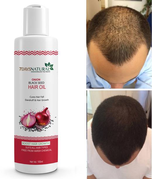 7days natural Onion Hair Growth Oil for Stronger Roots ...