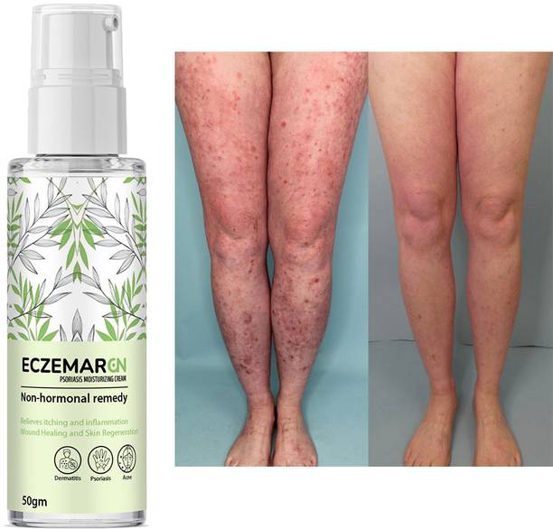 ONEAL Eczemaron Anti-Fungal Cream:Anti-Fungal Relief (50 ml)