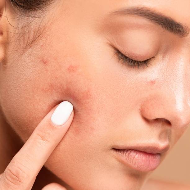 luzimaisa Best Pimple Remover - Rejuvenation & Cream