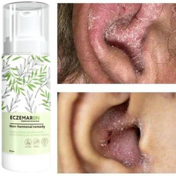 Ontario Eczemaron Fungal Spray | Regular Care Cream - Gentle Skin Friendly Texture Anti