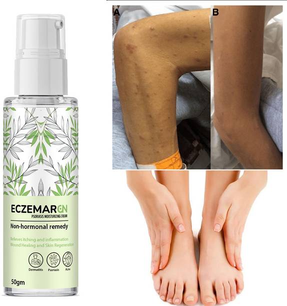 ONEAL Eczemaron anti fungal Powerful Anti-Fungal Relief Cream (50 ml)