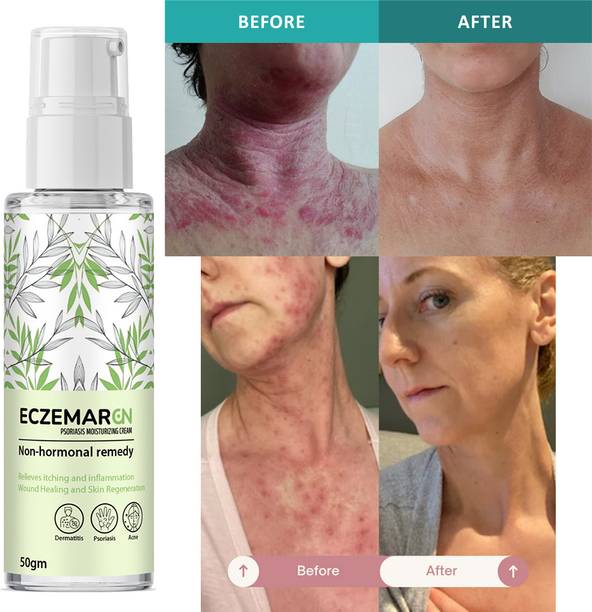 Vitra Eczemaron Anti Fungal Cream with Skin Whitening (50 ml)