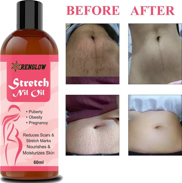 RENGLOW Natural Stretch bio oil-Before and After Pregnancy Stretch marks oil
