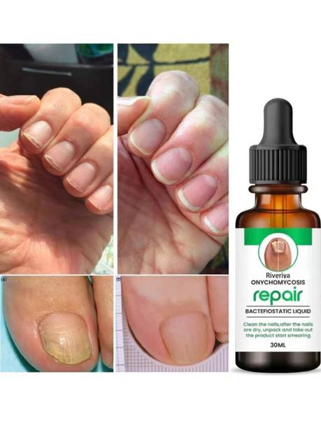 MOTYL Fungal Nail Treatment Liquid | Repair & Removal Solution for Nails (PACK OF 1) CLEAR