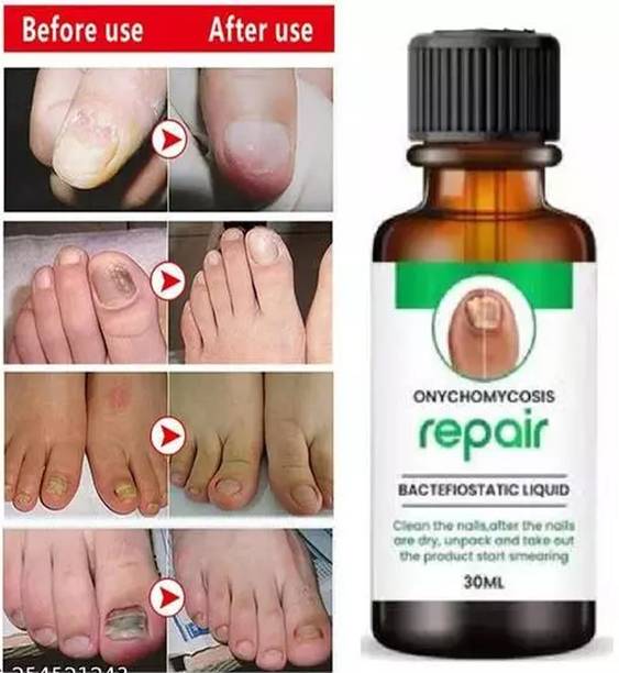 Vedlekha Nail Fungus Treatment Repair Foot Removal Toe Fungal Infection for nails Light Olive