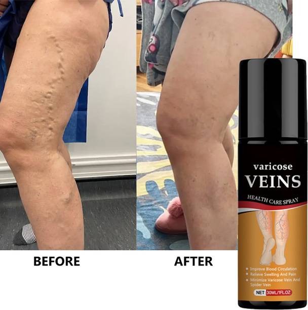 vvqvv Vein Health Spray – Herbal Relief for Varicose Veins & Heavy Legs Spray