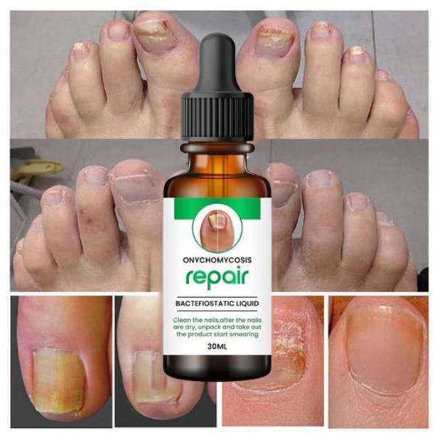 AQUORAL Nail Fungus Treatment And Repair Foot Toe Fungal Infection Oil For Nail Growth-1