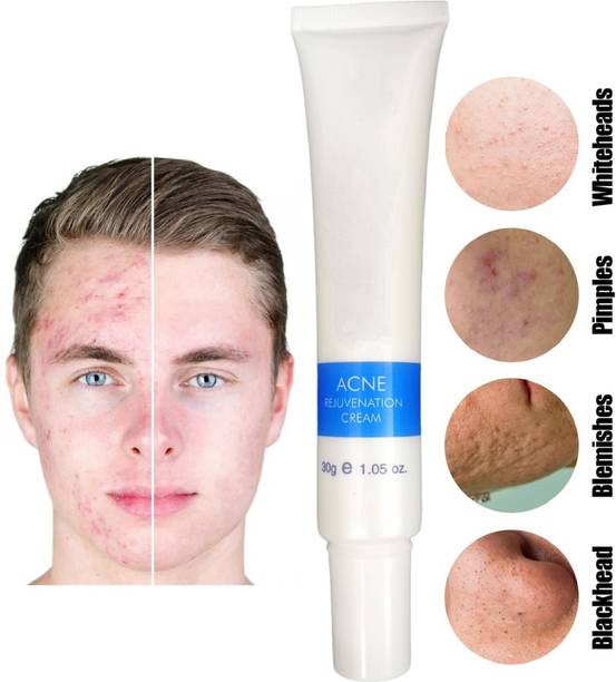 tanvi27 ACNE Removal Cream Gel Anti-Acne Scar Treatment Skin Care Face