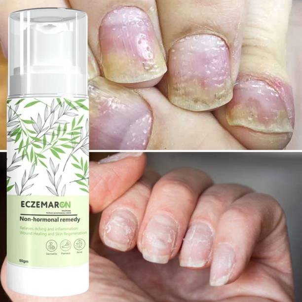 Eczemaron Ringworm Treatment Cream for Rapid Healing of Foot, Nail, and Skin Fungal Infections Men & Women (53 ml)