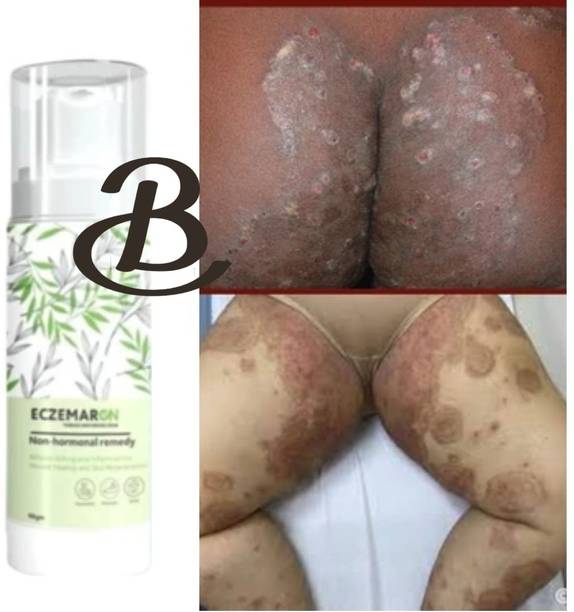 BIFRRUTANT Eczemaron Anti Fungal Cream Herbal Skin Care for Fungal Rash