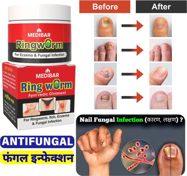 medibar Antifungal Nail Cream (Pack -1)