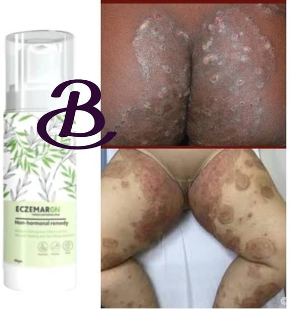BIFRRUTANT Eczemaron Anti Fungal Cream with Herbal Antifungal Formula