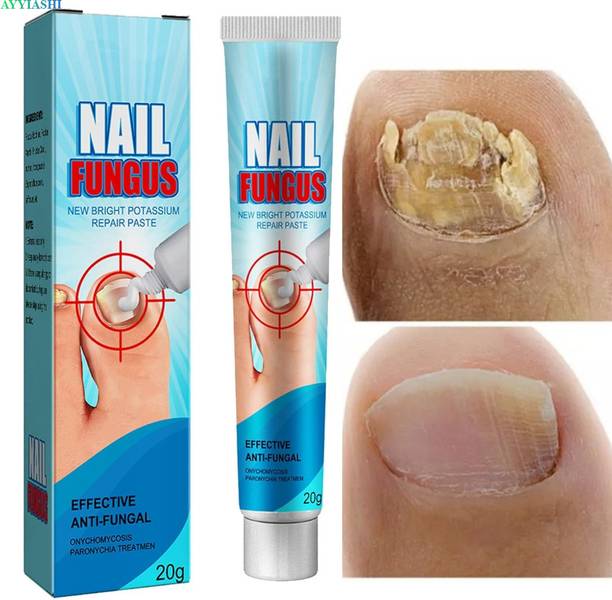AYYIASHI Nail Fungus Antifungal Cream With Deep Penetration And Nail Strength