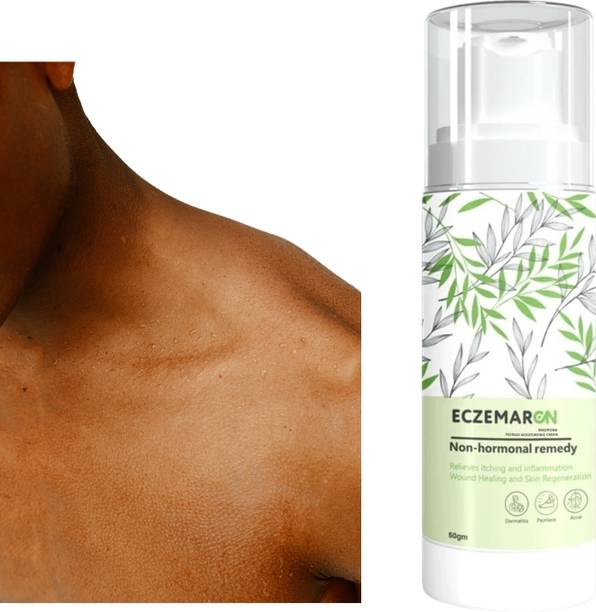 Eczemaron Ringworm Stretch marks| scar Removal Cream for women Men
