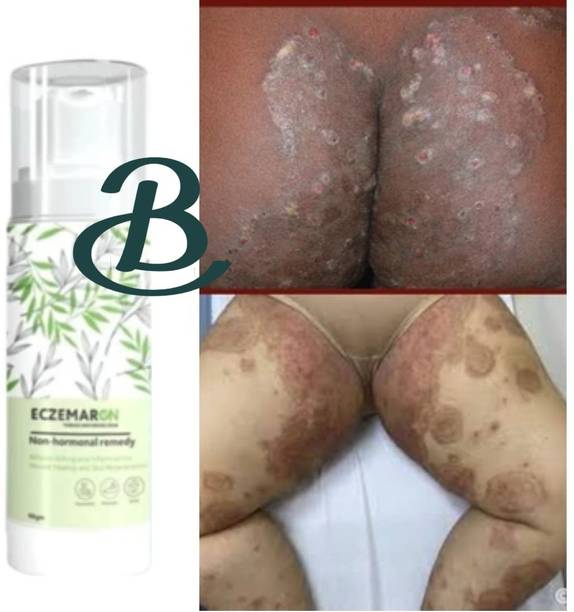 BIFRRUTANT Eczemaron Anti Fungal Cream Smoothens Fungal Affected Skin