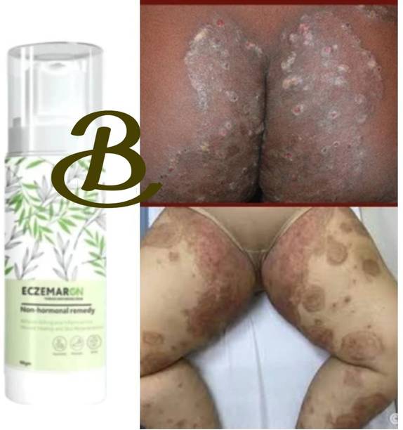 BIFRRUTANT Eczemaron Antifungal Cream for Quick Healing of Red, Itchy Rash