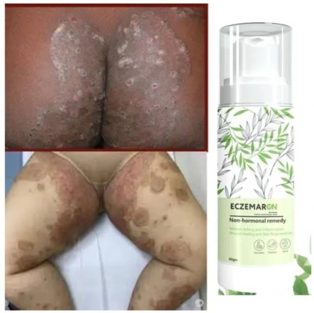 CHINCHA Eczemaron Anti Fungal Cream Benefits Guaranteed Solution- pack 1