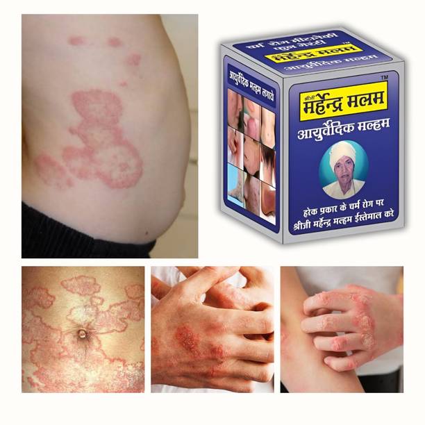 Rudramani Shreeji Marhendra Malam (FOR) Ringworm, itching, Eczema & Fungal Infection