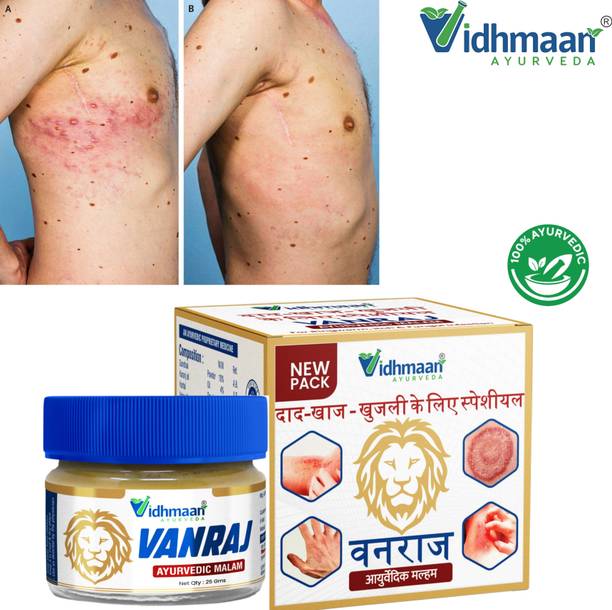 vidhmaan ayurveda Vanraj Ayurvedic Itch Cream – Skin Problem Solution