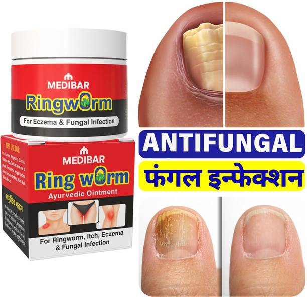 medibar Treatment of Ringworm and Fungal Nail Infections (Pack -1)