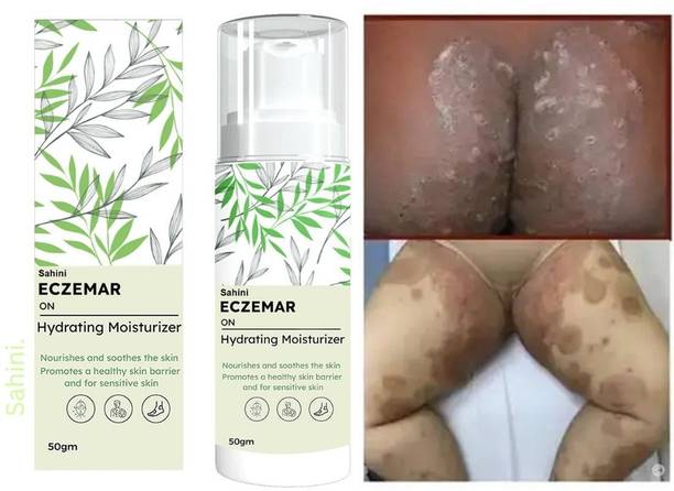 sahini Eczema Relief Cream with Herbal Extracts