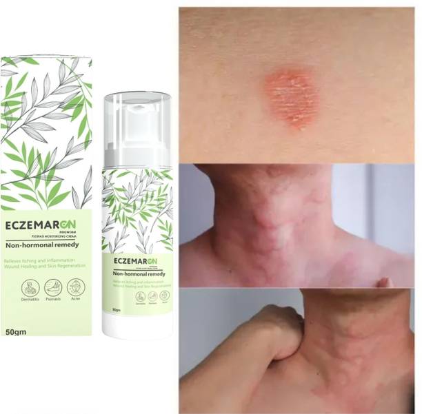 Eczemaron Ringworm Herbal Eczemaron Anti Fungal Cream For Men & Women Orignal Fungal Cream Khujli ...(1)