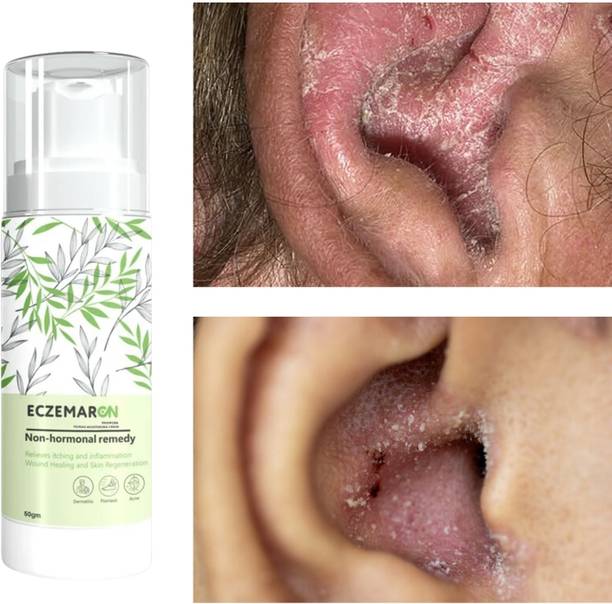 Eczemaron Ringworm Ayurvedic Fungal Cream For Men & Women Ayurvedic ItchCoat Anti fungal Malam for Ringworm itching Eczema lotion