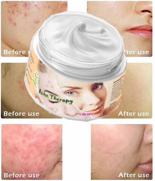 YAWI Best Acne Cream Anti Acne Moisturizing Skin Care Pimple Removal Cream