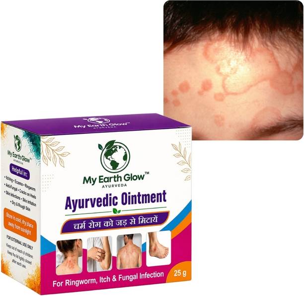 My Earth Glow Ayurveda Ringworm and Fungal Infection Ointment for Skin Care
