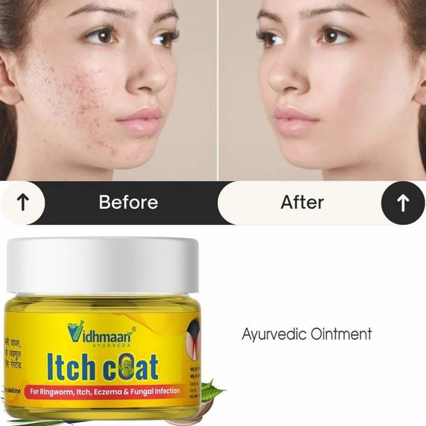 vidhmaan ayurveda Herbal Anti Itch Cream for Fungal Infection, Eczema, Skin Allergy & Ringworm Care Pack of 1