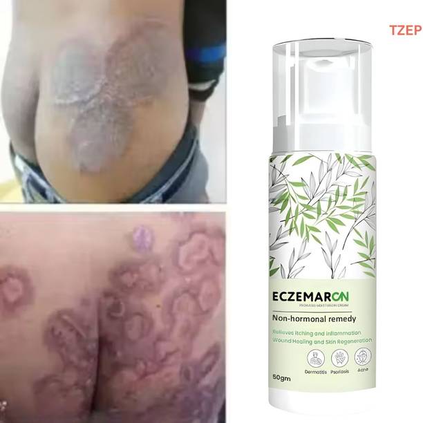 TZEP Eczemaron anti fungal cream advanced remedy to stop fungal infection spread