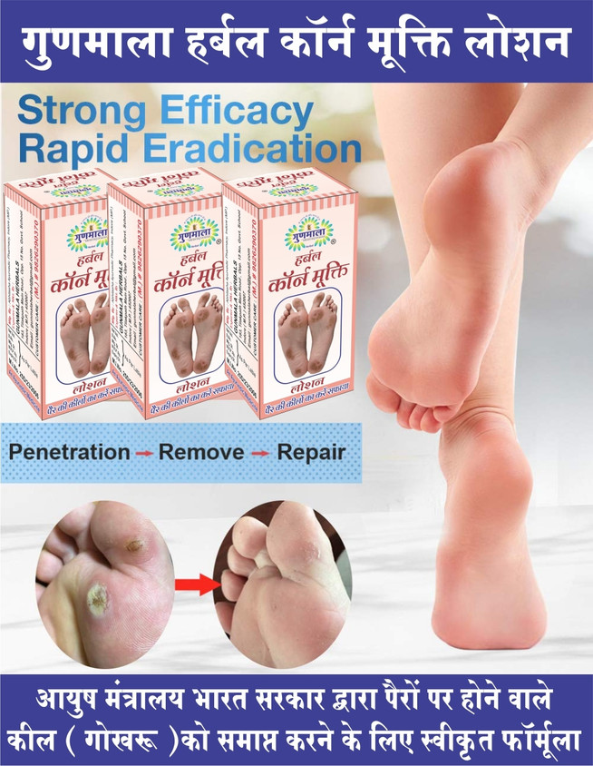 Of Foot Corn Heel Pain Callus Gunmala Foot Corn Remover Liquid For