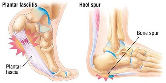 Anatomy Heal Foot Pain Anatomy Pain In Side Of Heal Side Of Heel