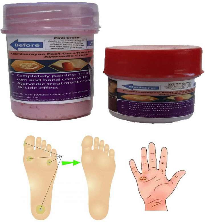 Corn in feet ayurvedic treatment shop