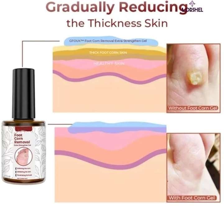 Remove corns naturally new arrivals