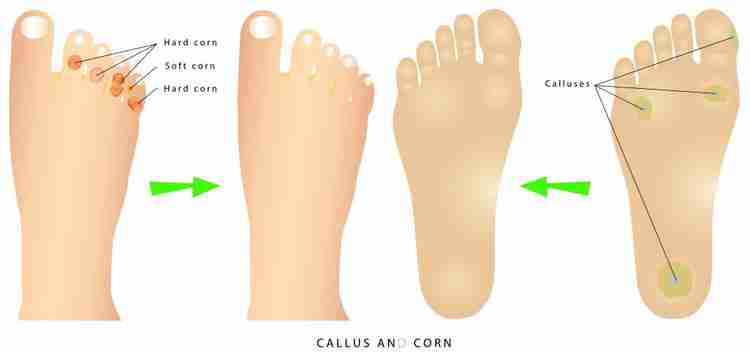 Feet best sale corn remover