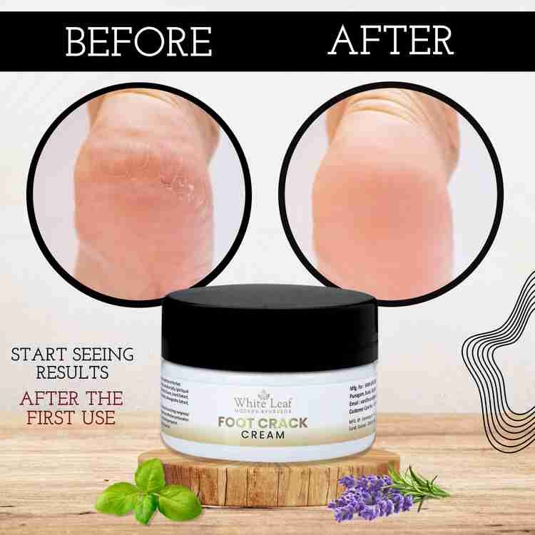 Cream for peeling skin on feet store