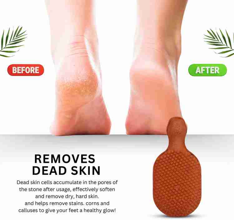 Natural remedies for hard skin on feet on sale