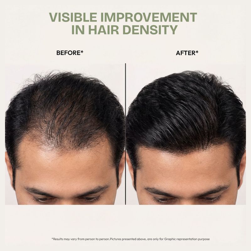 Proskire Ultimate Hair Growth Oil 100ml - Image 5