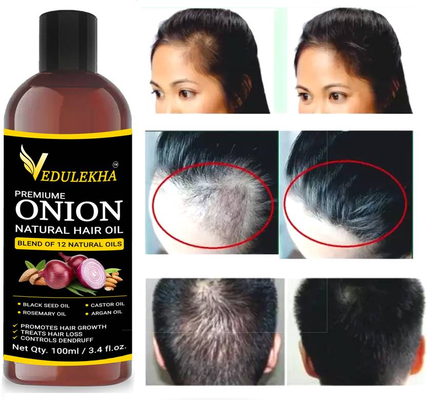 vedulekha Onion Hair Oil with 12 Essential Oils for Hair Regrowth