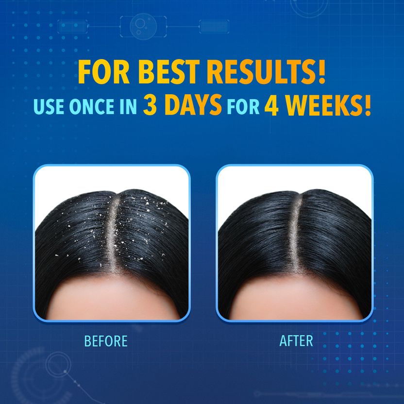 Scalpe Plus Anti Dandruff Shampoo 2 Pack of 2 · 75 ml (150 ml total) - Image 6
