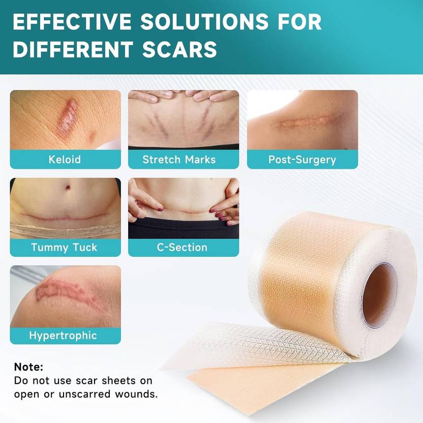 Varniecommerce pvt ltd Silicone Scar Sheets Roll (4cm x 1.5m) Interactive dressings Medical Dressing