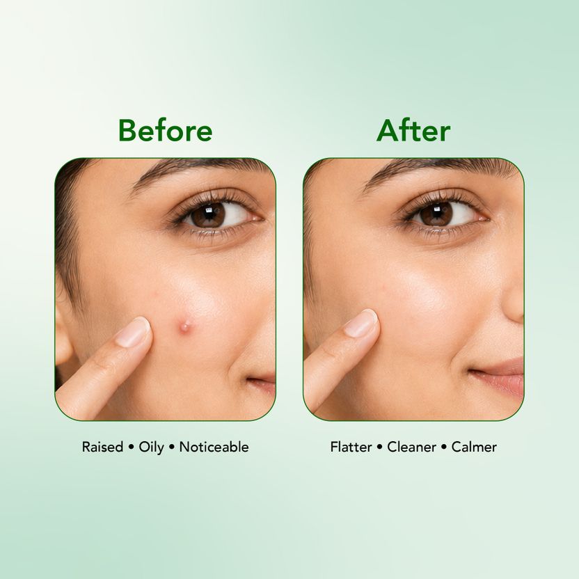 DR.RASHEL Acne Pimple Patches - Image 7