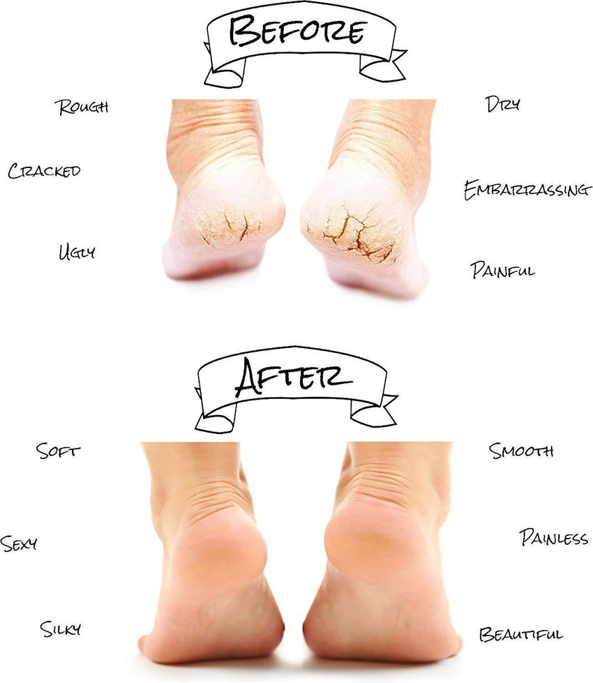 Tips for foot crack hot sale