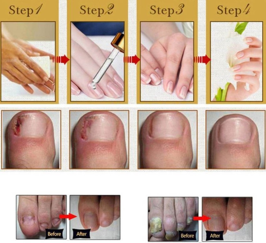 How Acrylic Nails Can Cause Fungus And How To Treat It