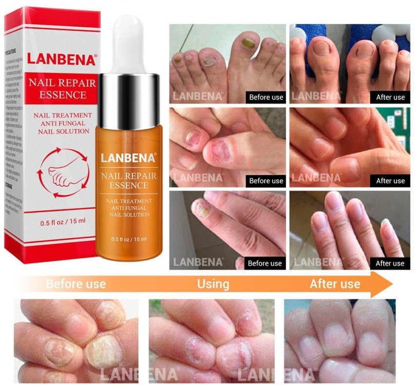 Buy Loceryl Nail Lacquer from Galderma in India
