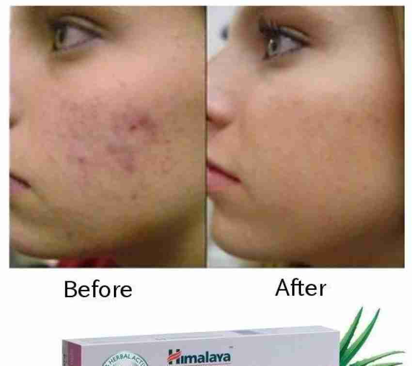 Himalaya acne and pimple 2025 cream review in hindi