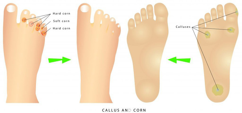 Feet corn remover new arrivals