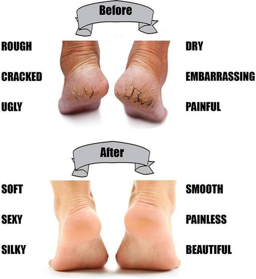 Classic deal Pain Relief Dry Hard Cracked Heel Repair Cream Foot Care Heel Support Buy Classic deal Pain Relief Dry Hard Cracked Heel Repair Cream Foot Care Heel Support Online at